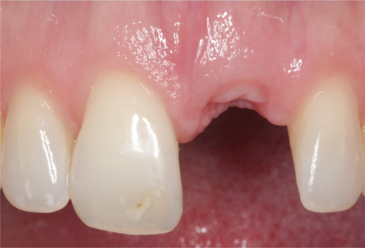 Der Kiefer wird vorbereitet für ein Zahnimplantat, das Bild zeigt eine Zahnlücke