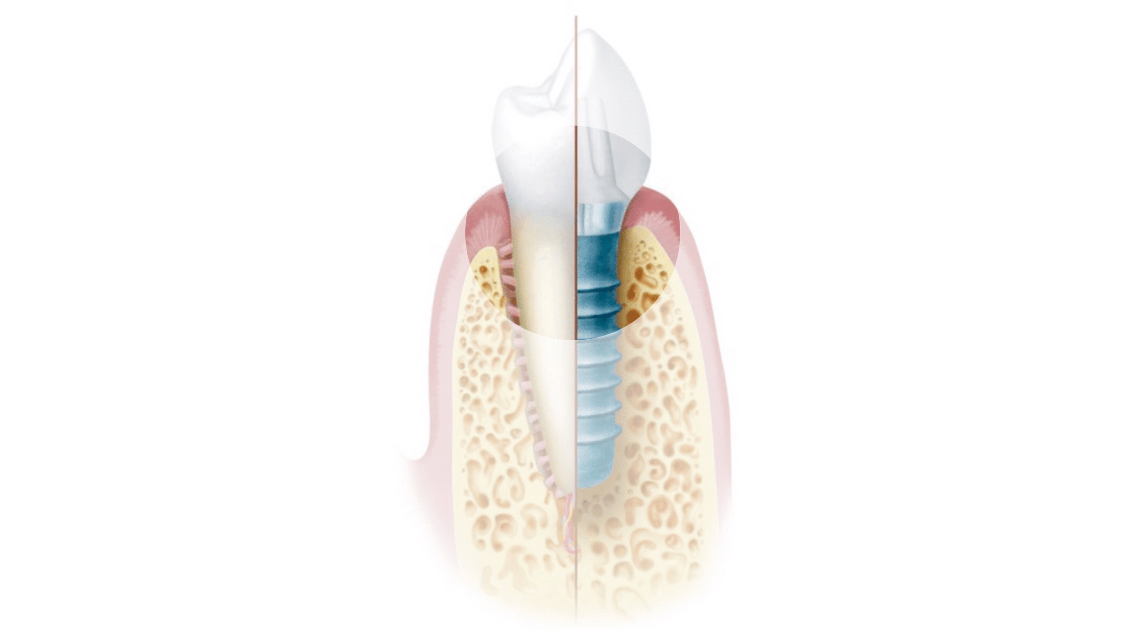 Schaubild welches zeigt wie ein Zahnimplantat aussieht